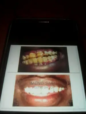 Teeth Whitening