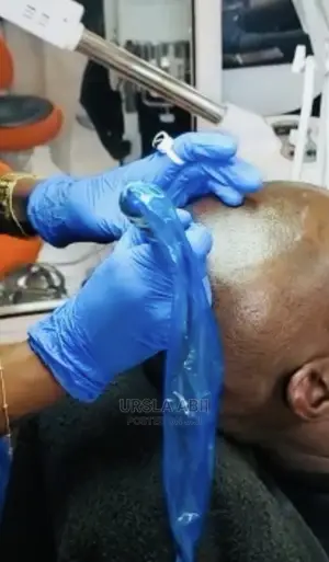 Hair Lose/Thinning Hair/Baldness