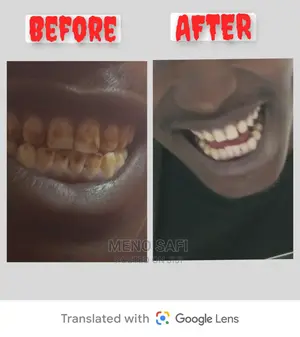 Dental Issues and Teeth Whitening