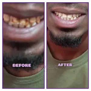 Teeth Cleaning and Whitening