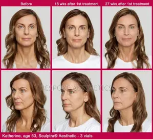 Sculptra 365mg