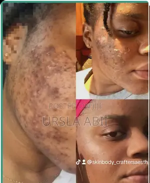 Acne/Melasma Treatment Chemical Peel