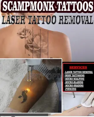 Tattoo Removal
