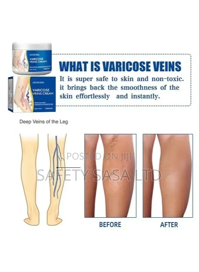 Vericose Vein Cream